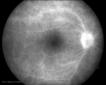 La uveítis es una inflamación del ojo.