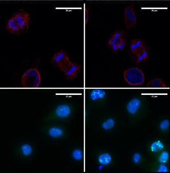 Células del melanoma donde se muestran alteraciones de la división celular (imágenes superiores) y un incremento de daño en el ADN (imágenes inferiores) cuando se elimina LOXL3. / UAM