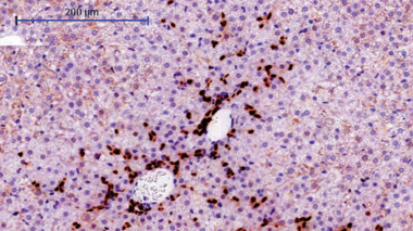<p>Sección de hígado de ratón en el que los hepatocitos expresan el oncogen URI. La imagen muestra la expansión de las células madre del hígado, llamada “reacción ductal”, en los primeros compases de la formación de un tumor. / CNIO </p>