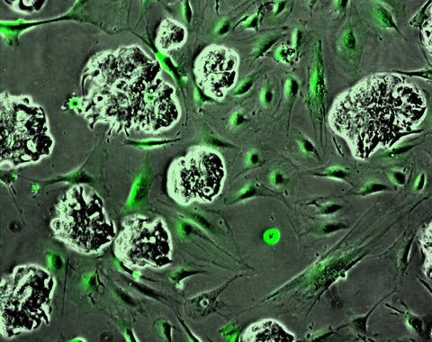 <p>Células tumorales en el estroma. Imagen: IRB.</p>