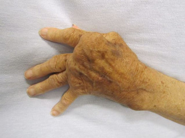 <p>Mano con artritis reumatoide. / <a href="https://en.wikipedia.org/wiki/Rheumatoid_arthritis#/media/File:Rheumatoid_Arthritis.JPG" target="_blank">Wikipedia</a></p>