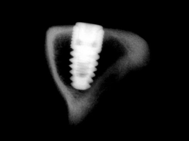 <p>Radiografía de tornillo implantado. / UJI</p>