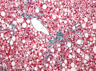 <p>Fotografía microscópica mostrando un hígado graso. / <a href="https://commons.wikimedia.org/wiki/File:Non-alcoholic_fatty_liver_disease1.jpg" target="_blank">Wikipedia</a></p>