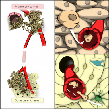 Gráfico de metástasis de un tumor primario de mama a huesos. / Formas Naturales para Inbiomotion, IRB Barcelona