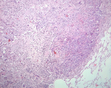 <p>Tejido tumoral procedente de un ratón con cáncer de pulmón. / Chiara Ambrogio. CNIO</p>