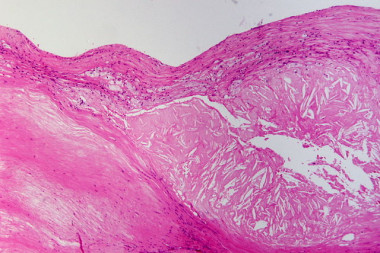 Placa aterosclerótica con vacíos de cristales de colesterol, macrófagos y fibrosis. / Patho