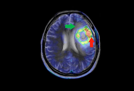 <p>Imagen de un glioblastoma múltiple, el más común y maligno de los tumores cerebrales. / SOM Biotech</p>