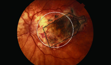 Según los autores, la células madre del implante se integraron con éxito con el tejido y la retina mostró cambios anatómicos consistentes con la reaparición del epitelio pigmentario / Kashani et al
