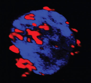 <p>Célula autoreactiva (azul) que capta los nanofármacos (rojo) que se agrupan en la membrana.</p>