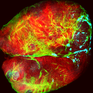 Tumor (rojo) cubierto por colágeno (verde) que está siendo depositado por células del sistema inmune (cian) / Mariana Muzzopappa, IRB Barcelona