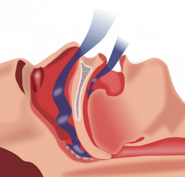 <p>Representación explicativa de la obstrucción en la ventilación que se produce en el síndrome de apnea del sueño. / Habib M’henni</p>