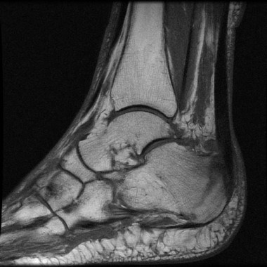 Radiografía de una fractura de tobillo. / Fundación Descubre