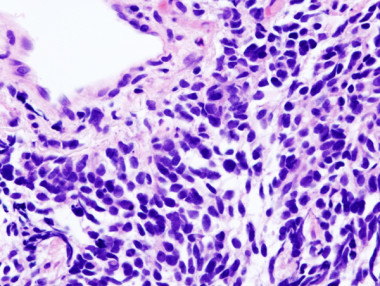 <p>Carcinoma de pulmón de células pequeñas. / <a href="https://en.wikipedia.org/wiki/Lung_cancer#/media/File:Lung_small_cell_carcinoma_(1)_by_core_needle_biopsy.jpg" target="_blank">KGH</a></p>