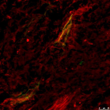 <p>Detección de óxido nítrico (en rojo) cerca de los vasos sanguíneos (detectados mediante microangiografía; en verde) que irrigan un tumor, tras aumentar los niveles de SOD3. El amarillo indica la superposición de los dos colores. / Santos Mañes, CNB-CSIC</p>