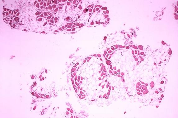 <p>En la foto, histopatología del músculo gastrocnemio (gemelos) de un paciente con distrofia muscular de Duchenne, el trastorno neuromuscular más frecuente en niños. Imagen: Wikipedia.</p>