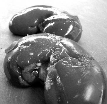 Una proteína de las neuronas mata a las células del riñón en la insuficiencia renal por diabetes