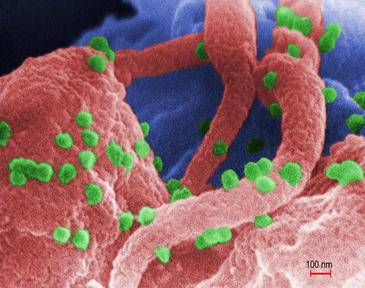 virus sida