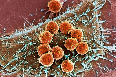 <p>Los linfocitos T del sistema inmunitario (en color naranja) se unen a una célula tumoral para destruirla. / Memorial Sloan Kettering </p>