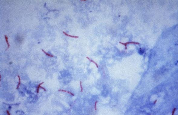<p><em>Mycobacterium tuberculosis</em> visualización usando la tinción de Ziehl-Neelsen.Fuente: wikipedia</p>