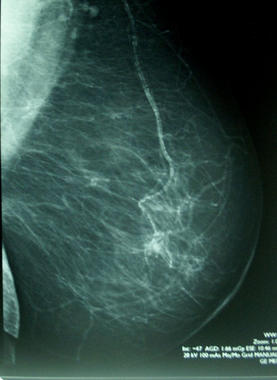 <p>Imagen de una mamografía. Foto: Wikipedia.</p>