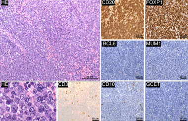 <p>CREBBP permite explicar el mecanismo de evolución del linfoma folicular. En la imagen, muestras de biopsias. / PNAS</p>