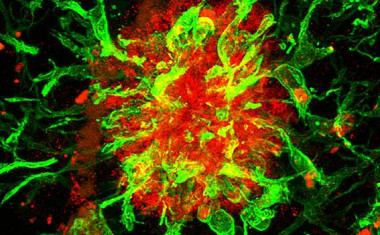 <p>Ejemplo de una placa amiloidea humana positiva para la proteína SFRP1 (rojo) y rodeada de células gliales (verde). / Pilar Esteve</p>