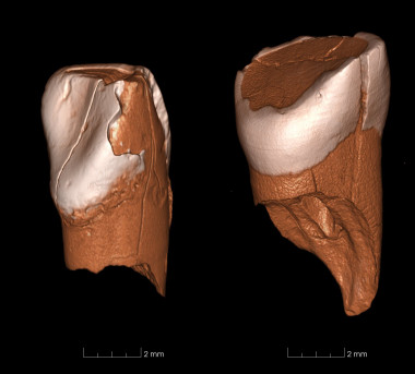 <p>Modelos digitales en tres dimensiones del incisivo inferior de Riparo Bombrini (izquierda) y del incisivo superior de la Cueva de Fumane / Daniele Panetta, Instituto de Fisiología Clínica, Pisa (Italia).</p>