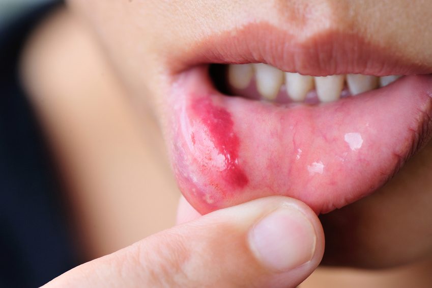 Canker sores and oral sex That canker sores and oral sex absolutely not