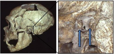 <p>El cráneo de un hombre Neandertal con exóstosis (oído de nadador) / Erik Trinkaus</p>