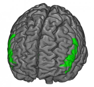 <p>Esquema de las redes neuronales asociadas con los síntomas del Trastorno por Déficit de Atención con Hiperactividad (TDAH). Imagen: Robert Whelan/ Hugh Garavan.</p>