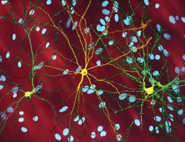 <p>Imagen de microscopio de las neuronas espinosas medias (amarillo) con inclusiones nucleares (naranja), producidas como parte del proceso de la enfermedad de Huntington. / Steven Finkbeiner / Wikipedia</p>