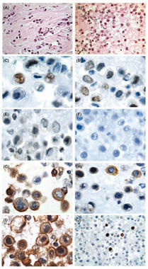 <p>En las imágenes, tumores primarios y metástasis. Foto: Nature.</p>