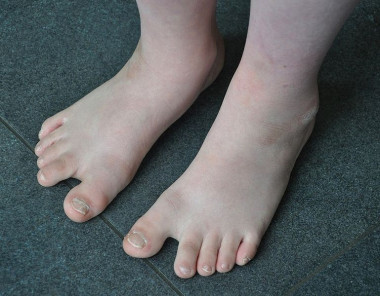 <p>Las personas con síndrome de Down sufren discapacidad cognitiva, alzhéimer temprano, mayor riesgo de leucemia infantil, defectos cardíacos e inmunológicos y disfunción del sistema endocrino. / <a href="https://en.wikipedia.org/wiki/File:Feet_of_a_boy_with_Down_Syndrome.JPG" target="_blank">Wikipedia</a></p>