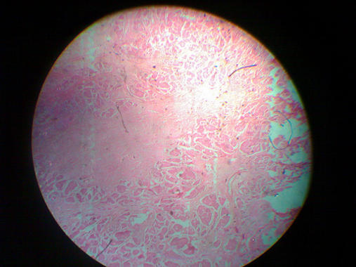 <p>En la imagen un <a href="http://plataformasinc.es/index.php/esl/En-exclusiva/Imagenes-embargadas/Una-caracteristica-del-tejido-mamario-puede-predecir-el-riesgo-de-cancer-de-una-mujer" target="_self">carcinoma ductal invasivo de mama</a>. Foto: Prep4md.</p>