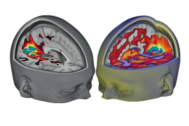 <p/>Resonancia magnética funcional de los cerebros de una persona bajo los efectos del LSD. / Carhart-Harris et al” /><span style=