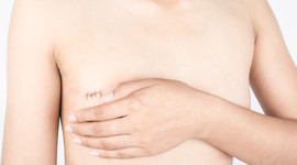 Mujer con mastectomía