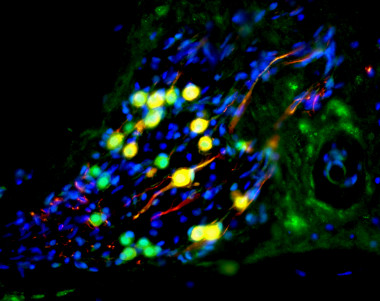 <p>Una neurona auditiva derivada de células madre repuebla la cóclea de un jerbo sordo. Las células humanas son las coloreadas en verde. El color rojo es un marcador de diferenciación neuronal. Imagen: Marcelo Rivolta, Universidad of Sheffield.</p>