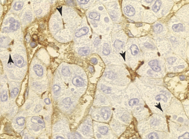 <p>ICAM-1 se confina en la parte apical (flechas) de las células epiteliales de hígado que permanecen sanas y funcionales. Inmunohistoquímica de un hígado infectado con el virus de la hepatitis C. </p>