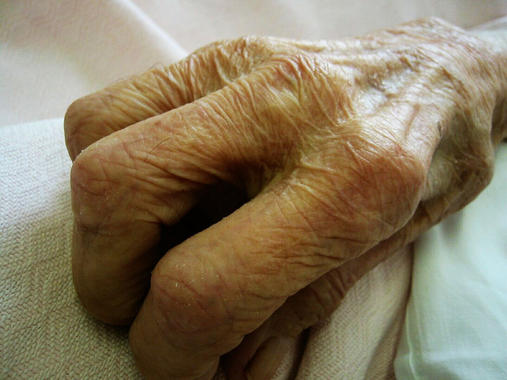 <p>En patologías como la fatiga crónica y el propio envejecimiento existen datos, aunque no definitivos, de los beneficios de la melatonina. Imagen:<a href="http://www.flickr.com/photos/sarchi/266800522/sizes/l/" target="_self"> Sarchi.</a></p>