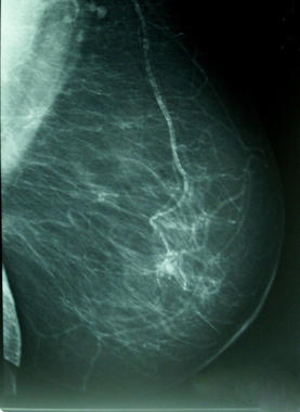 <p>Desde hace tiempo es conocido el papel que desempeña la densidad mamográfica en el cáncer de mama. Imagen: A. Avendaño/Wikipedia.</p>
