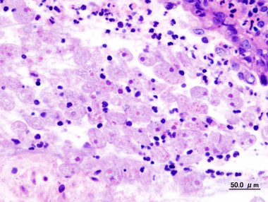 <p>Tejido del colon afectado por amebiasis. Imagen:<a href="http://upload.wikimedia.org/wikipedia/commons/d/d4/Amoebic_dysentery_in_colon_biopsy_(1).jpg?uselang=es;" target="_self"> Wikipedia</a></p>
