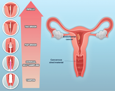 <p>Tipos de muestreos en cáncer de endometrio. / IDIBELL-ICO</p>