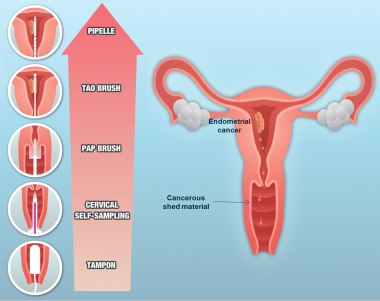 <p>Tipos de muestreos en cáncer de endometrio. / IDIBELL-ICO</p>