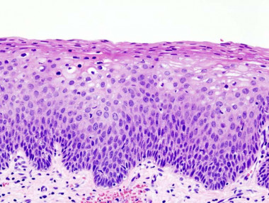<p>Células al microscopio de cáncer de cervix, una enfermedad que se podría tratar con hipertermia. Imagen: Wikipedia.</p>