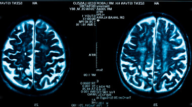 <p>El 78% de los casos de daño cerebral tuvieron su origen en un ictus, y el 22% restante, en traumatismos craneoencefálicos. / UPM</p>