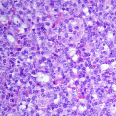 <p>Leucemia linfoblástica aguda. / CIC</p>