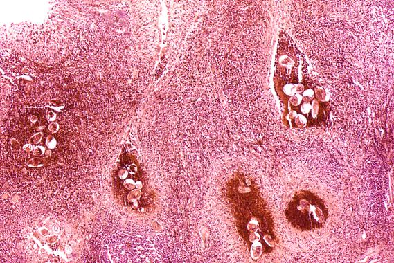 <p>Fotomicrografía de una vejiga infectada por<em> S. haematobium</em>. / <a href="http://en.wikipedia.org/wiki/Schistosomiasis#mediaviewer/File:Schistosoma_bladder_histopathology.jpeg" target="_blank">Wikipedia</a></p>