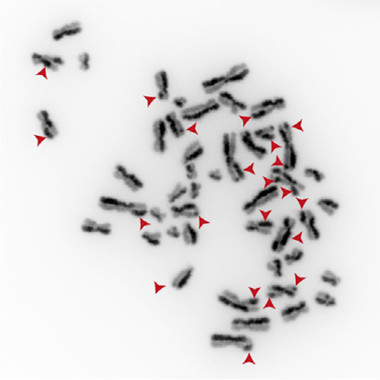 <p>Cromosomas de células con mutaciones en el gen TOP3A que presentan numerosos intercambios SCE (<em>Sister chromatid exchange</em>) / UAB</p>