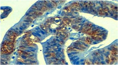 <p>Sección de un cáncer de estómago vista al microscopio mostrando expresión aberrante de la proteina YBX1 (teñida de color marrón). / IDIBELL</p><p><strong> </strong></p>