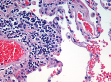 <p>Tinción de un pulmón enfisematoso terminal. Hay un gran espacio irregular de aire rodeado por una gran cantidad de células infiltradas (azules) y sangre (rojo). / <a href="http://es.wikipedia.org/wiki/Enfisema_pulmonar#mediaviewer/File:Emphysema_H_and_E.jpg" target="_self">Wikipedia</a></p>